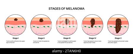 Stadi del melanoma, illustrazione Foto Stock