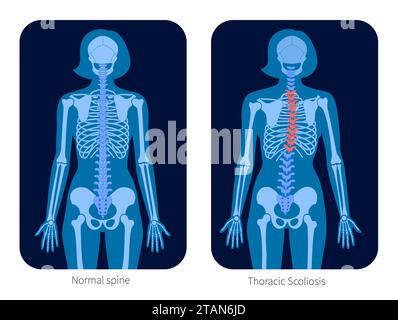 Colonna vertebrale sana e scoliosi, illustrazione Foto Stock