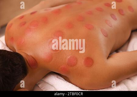 Vista ravvicinata dell'uomo dopo la terapia di coppettazione in ambienti chiusi Foto Stock