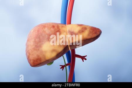 Organo epatico con stato fegato grasso, rendering 3D. Illustrazione 3D. Foto Stock