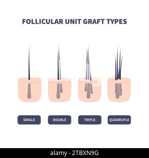 Microinnesti per capelli, illustrazione concettuale Foto Stock