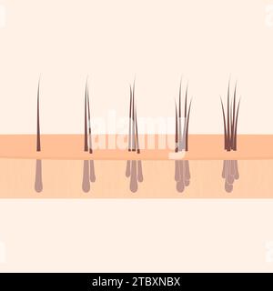 Tipi di innesto dei capelli, illustrazione concettuale Foto Stock