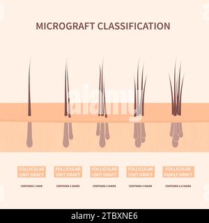 Tipi di innesto dei capelli, illustrazione concettuale Foto Stock