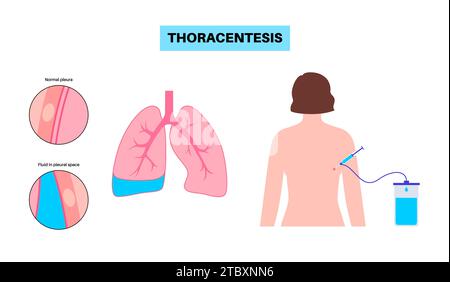 Procedura medica toracentesi, illustrazione Foto Stock