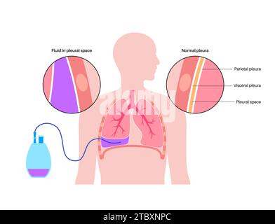 Catetere pleurico con tunnel, illustrazione. Foto Stock