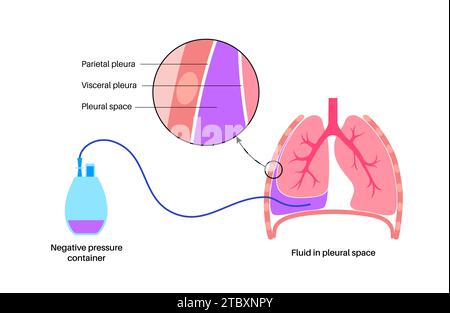 Catetere pleurico con tunnel, illustrazione Foto Stock