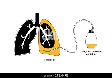 Catetere pleurico con tunnel, illustrazione. Foto Stock