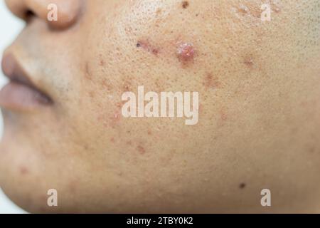 problemi alla pelle. problema di acne infiammata sul viso. L'acne infiammata consiste di gonfiore, arrossamento e pori che sono gravemente intasati da batteri, o Foto Stock