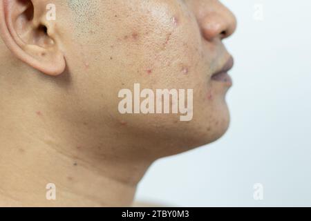 problemi alla pelle. problema di acne infiammata sul viso. L'acne infiammata consiste di gonfiore, arrossamento e pori che sono gravemente intasati da batteri, o Foto Stock