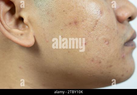 problemi alla pelle. problema di acne infiammata sul viso. L'acne infiammata consiste di gonfiore, arrossamento e pori che sono gravemente intasati da batteri, o Foto Stock