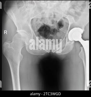 Frattura del collo femorale sinistro. Roentgenogram. Il giorno successivo alla sostituzione totale dell'anca Foto Stock