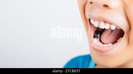 Immagine dentale di una corona in acciaio inossidabile un cappuccio in argento utilizzato per ripristinare i denti dei bambini colpiti da Foto Stock