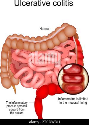 Colite ulcerosa. Malattia infiammatoria intestinale IBD. Intestino crasso e tenue realistico con il processo infiammatorio che si diffonde verso l'alto dal re Illustrazione Vettoriale