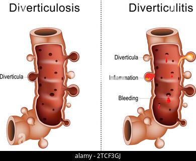 Differenza tra diverticolite e diverticolosi del colon. Primo piano di una parte dell'intestino crasso con diverticoli, sanguinamento e infiammazione, UM Illustrazione Vettoriale