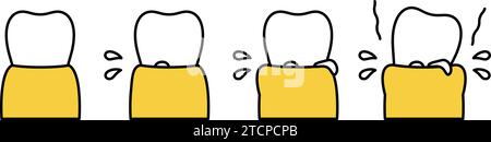 Illustrazione dell'immagine di progressione della malattia parodontale, semplice disegno di linee, illustrazione vettoriale Illustrazione Vettoriale