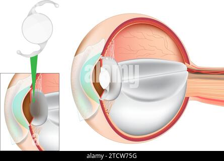 Intervento chirurgico di sostituzione dell'obiettivo oculare. Impianto lente. Chirurgia della cataratta. Lenti intraoculari IOL. Illustrazione Vettoriale