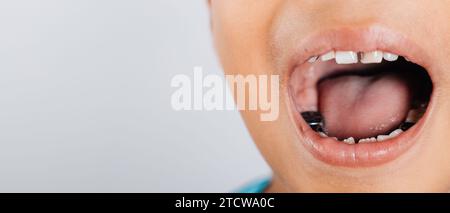 Corona in acciaio inox un trattamento dentale per ripristinare il dente di un bambino dopo un lungo decadimento o. Foto Stock