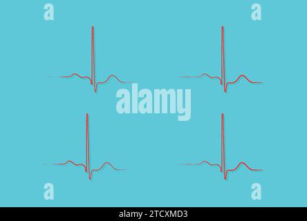 Ripolarizzazione ventricolare, ciclo cardiaco, ECG cardiaco nel ritmo sinusale normale, intervallo QT dell'ECG. Illustrazione Vettoriale