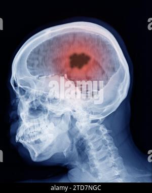 Risonanza magnetica cerebrale che mostra cancro cerebrale risultante, ascesso cerebrale. Foto Stock