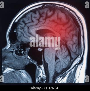 Scansione RM del cervello che mostra emorragia intracerebrale risultante in ICH cerebrale Foto Stock