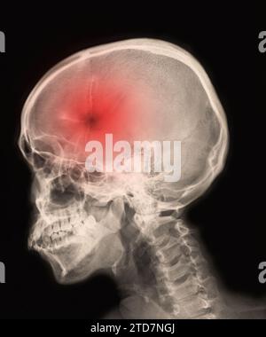 Scansione RM del cervello che mostra il risultato dell'emorragia intracerebrale cerebrale, ICH Foto Stock