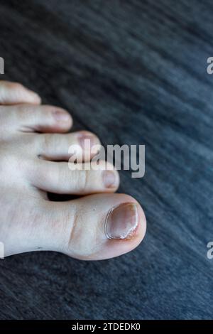 Vista del distacco parziale dell'unghia del piede dal letto delle unghie a causa di onicolisi, infezione fungina Foto Stock