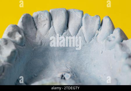 Intonaco blu impressione della mascella dentale di un paziente con denti storti e malocclusioni su sfondo giallo. Produzione di controventature per correggere il morso Foto Stock