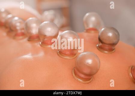 Terapia di coppettazione. Vista ravvicinata dell'uomo con tazze di vetro sul retro al chiuso Foto Stock