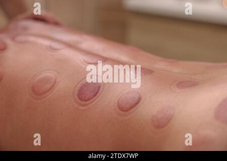 Vista ravvicinata dell'uomo dopo la terapia di coppettazione in ambienti chiusi Foto Stock