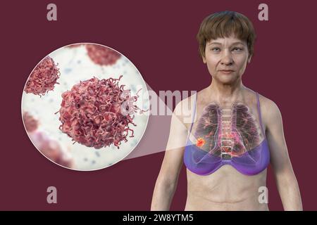 Donna con cancro ai polmoni, illustrazione Foto Stock