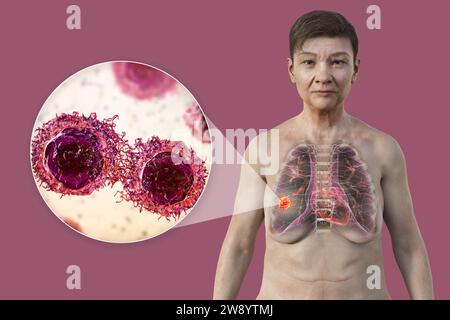 Donna con cancro ai polmoni, illustrazione Foto Stock