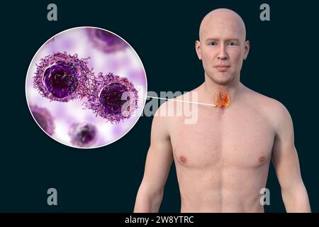 Cancro della tiroide, illustrazione Foto Stock