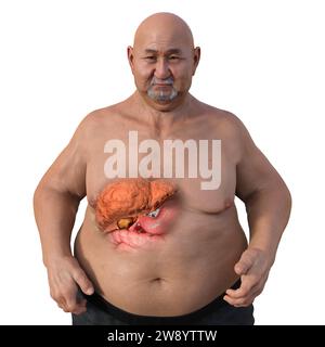 Uomo in sovrappeso con steatosi epatica, illustrazione Foto Stock