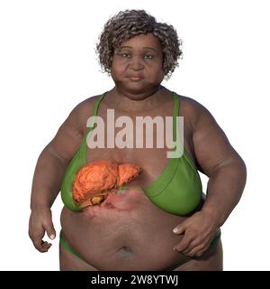 Illustrazione con una donna in sovrappeso con pelle trasparente, che mostra il fegato ed evidenzia la presenza di steatosi epatica. Foto Stock