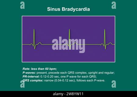 Bradicardia sinusale ritmo cardiaco, illustrazione Foto Stock