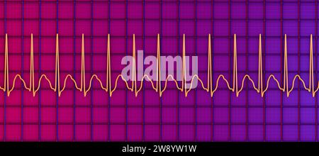 Tachicardia sopraventricolare ritmo cardiaco, illustrazione Foto Stock