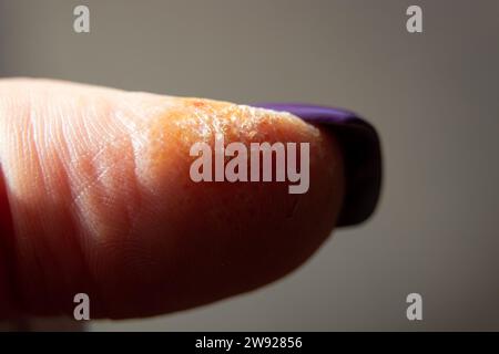 Reazione allergica ed eruzione cutanea sulle dita, irritazione cutanea, primo piano della pelle secca Foto Stock