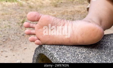 La donna soffre di dolore ai piedi causato dal piede dell'atleta. Il paziente soffre di grave malattia della pelle del piede. Foto ravvicinata della malattia del piede, Concep Foto Stock