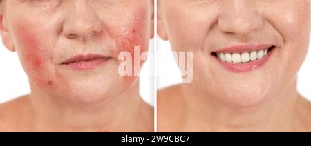 Prima e dopo il trattamento con rosacea. Foto di una donna su sfondo bianco, primo piano. Collage che mostra pelle colpita e sana Foto Stock