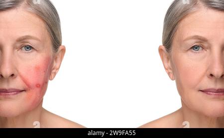 Prima e dopo il trattamento con rosacea. Foto di una donna su sfondo bianco, primo piano. Collage che mostra pelle colpita e sana Foto Stock