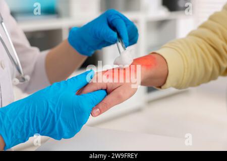 Medico che cura la mano bruciata del paziente in ospedale, primo piano Foto Stock