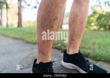 Primo piano di una gamba con dermatite che gratta le vesciche. Arrossamento, prurito cutaneo, eruzione cutanea. Foto Stock