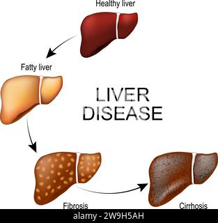Malattie del fegato. Cambiamenti di tessuto di un organo interno umano da fegato sano e grasso a fibrosi e cirrosi. Stadi del danno epatico. Illu. Vettore Illustrazione Vettoriale