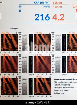 Lo studio di esame FibroScan del fegato ha rivelato F0 per la rigidità epatica, S0 per la steatosi epatica, lettura fibrosi 4,2 kPa, attenuazione cattura CAP pa Foto Stock