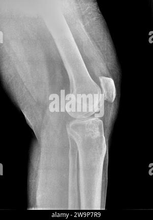 Pellicola radiografica o radiografia di un ginocchio normale. La vista laterale mostra la normale struttura ossea della rotula della tibia e della fibula del femore, lo spazio articolare è normale con un fabe Foto Stock