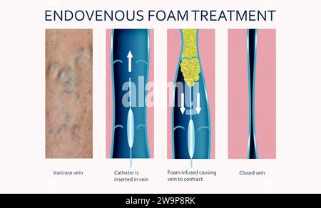 Trattamento laser endovenoso per vene varicose - concetto di scleroterapia della schiuma. Prima e dopo. Struttura venosa Foto Stock
