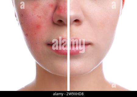 Prima e dopo il trattamento con rosacea. Foto di una donna su sfondo bianco, primo piano. Collage che mostra pelle colpita e sana Foto Stock