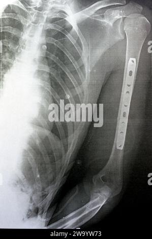 Radiografia semplice che mostra frattura dell'omero sinistro dell'albero intermedio trasversale causata da un trauma diretto in un incidente stradale, gestito da riduzione aperta e fissa interna Foto Stock