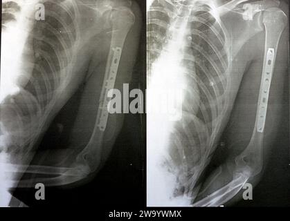 Radiografia semplice che mostra frattura dell'omero sinistro dell'albero intermedio trasversale causata da un trauma diretto in un incidente stradale, gestito da riduzione aperta e fissa interna Foto Stock