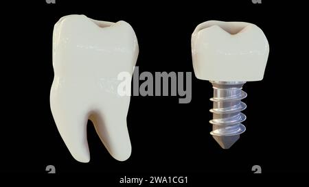 rendering 3d di un impianto di denti e denti umani sani su sfondo nero Foto Stock